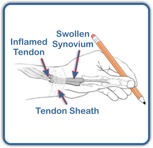 Wrist Pain from Tenosynovitis – Coon Rapids Chiropractic